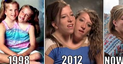 What Are Famous Conjoined Twins Abby And Brittany Hensel Up To Today
