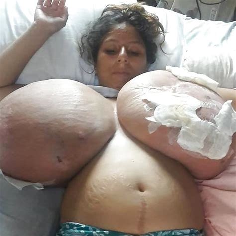 Massive Tits Breast Reduction Pics Xhamster My Xxx Hot Girl