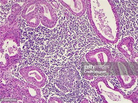 Salivary Gland Cancer Photos And Premium High Res Pictures Getty Images