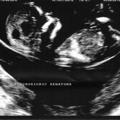 1 Two Dimensional Ultrasonography Scan Of A Subchorionic Hematoma In A