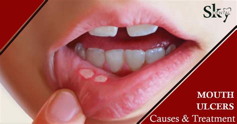 Mouth Ulcers Treatment And Tips Sky Dental Care