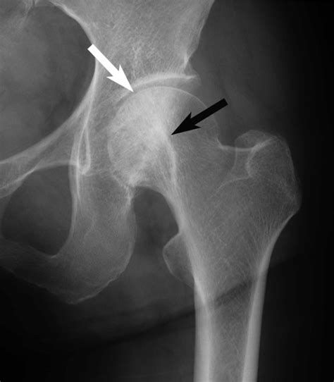 Radiograph Of The Left Hip Joint At 12 Months After The Onset Of Pain