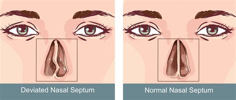 Nasal Septal Perforation Repair Overview Causes Symptoms Treatment Illness Com