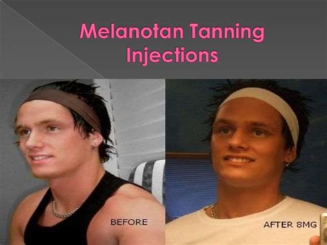 Melanotan Tanning Injections