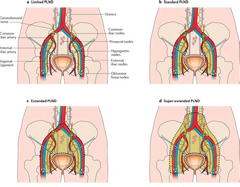 Pelvic Lymph Node Dissection During Radical Cystectomy For Muscle