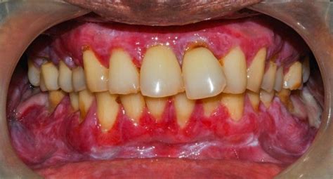 Oral Lichen Planus On Gums The Gums Appear To Be Inflamed With White