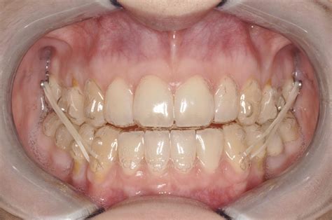 Jennas Invisalign Journey Month 2 Crownwood Dental