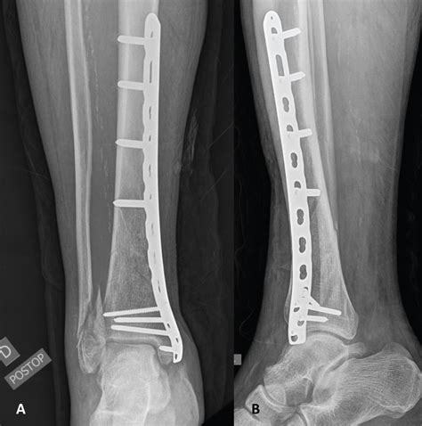 Fixation Of A Distal Diaphyseal Tibia Fracture With Neurovascular