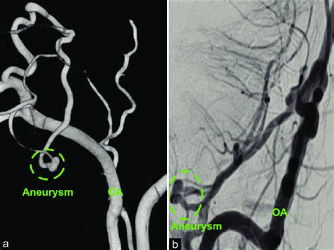 A A 3d Reconstruction Of The Left Occipital Artery Angiogram That