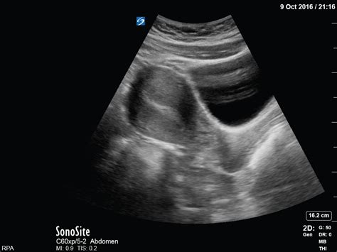 Missed Miscarriage 13 Weeks Critical Care Sonography