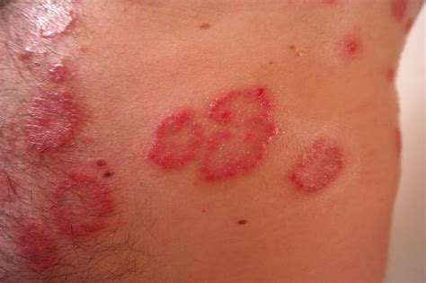 Early Signs Of Shingles Symptoms And Treatment Of The Chickenpox