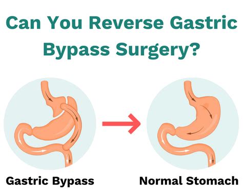 Gastric Bypass