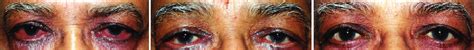 A Periocular Erythema Edema Conjunctival Congestion With Mild