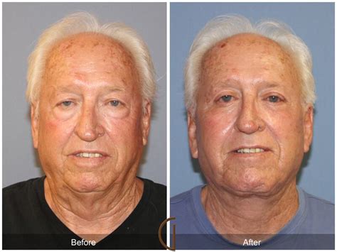 facelift for men in newport beach ca dr kevin sadati