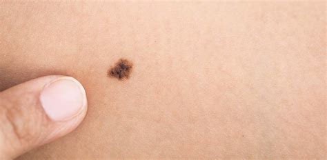 The Stages Of Melanoma Development Critical Health Information You