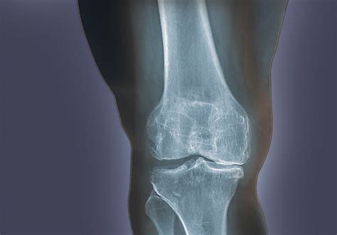 Asymptomatic Hyperuricemia Predictive Of Radiographic Knee