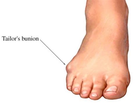 3 Ways That You May Develop Bunions Podiatry Hq