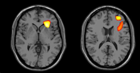 The Adolescent Brain Develops Differently In Bipolar Disorder Yalenews