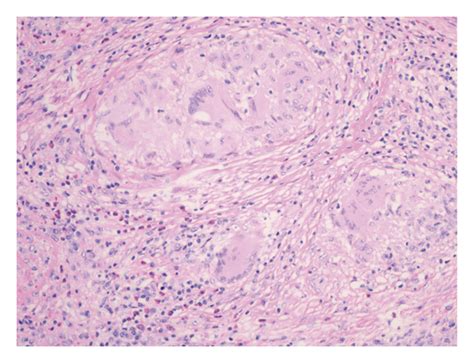 Sarcoidosis And Its Splenic Wonder A Rare Case Of Isolated Splenic