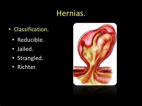 Hernias Ingl
