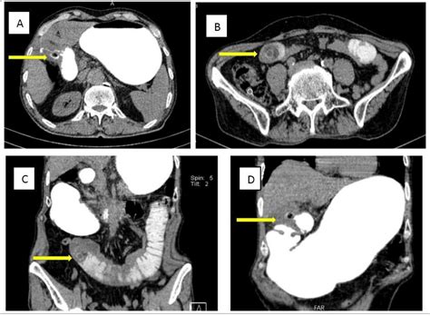 Cureus The Diagnosis And Management Of Recurrent Gallstone Ileus A