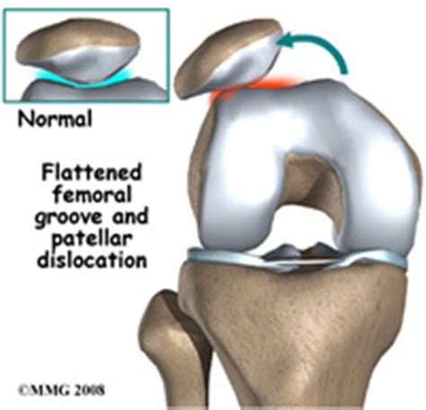 Patella Instability Brisbane Knee And Shoulder Clinic Dr