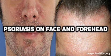 How To Manage Psoriasis On Face And Forehead Psoriasis Self Management