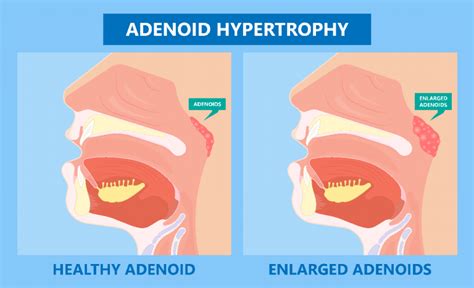 Tonsils And Adenoids Common Problems Pre And Post Surgery Care