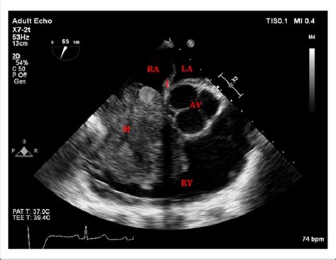 Two Dimensional Midesophageal Right Ventricular Inflow Outflow View