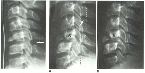 Pdf Flexion Teardrop Fracture Of The Cervical Spine Radiographic