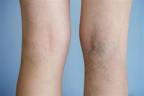 Varicose Veins How To Know If You Need A Varicose Veins Specialists