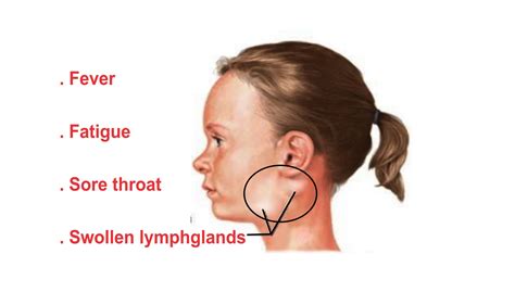 The Gallery For Swollen Lymph Nodes In Jaw