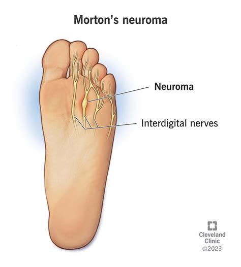 Mortons Neuroma Understanding Managing And Finding Relief