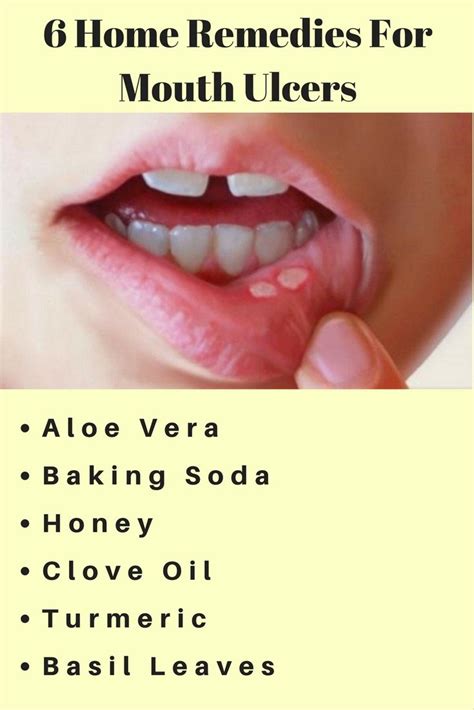 Top 6 Home Remedies For Mouth Ulcers Natural Treatment Of Ulcers