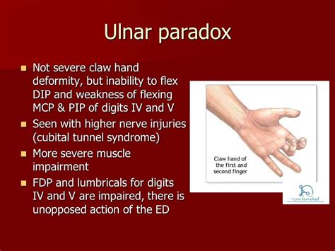 Claw Hand And Ulnar Paradox How To Relief