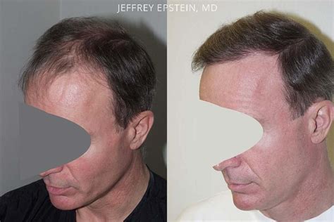 Hair Transplants For Men Photos Miami Fl Patient38430