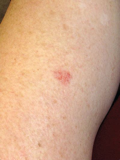 Skin Cancer Lesions On Arms