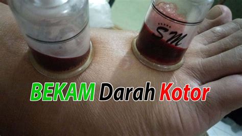 Bekam Jakarta Barat Homecare24