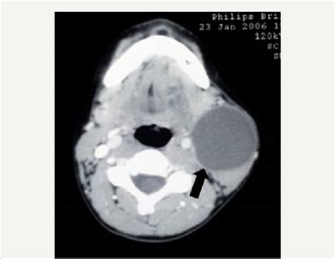 Axial Ct Image In A Child With A Second Branchial Cleft Cyst Arrow