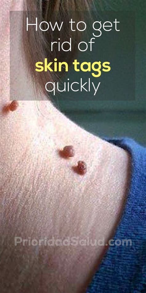 10 effective ways to remove skin tags naturally skin tags on face skin tag removal skin tags