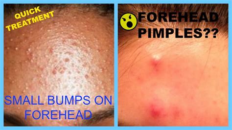 Acne Home Remedies For Dry Skin Forehead Pimples Home Remedies