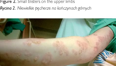 Figure 3 From Pemphigoid Gestationis A Rare Dermatosis Of The