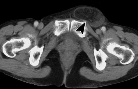 Differentiation Of Femoral Versus Inguinal Hernia Ct Findings Ajr