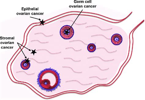 Different Types Of Ovarian Cancer Stars Indicate The Developmental