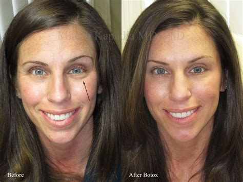 Transformative Results Eye Botox Before And After Beautykylie