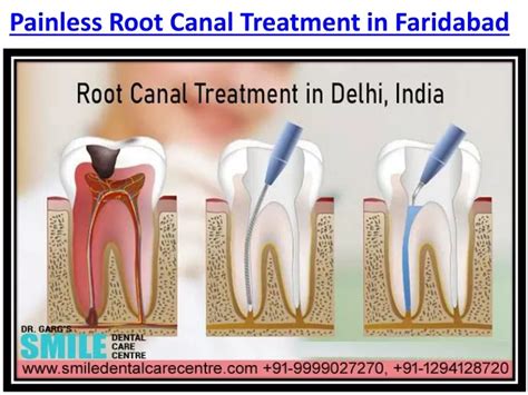 Ppt Visit For Painless Root Canal Treatment In Faridabad Powerpoint