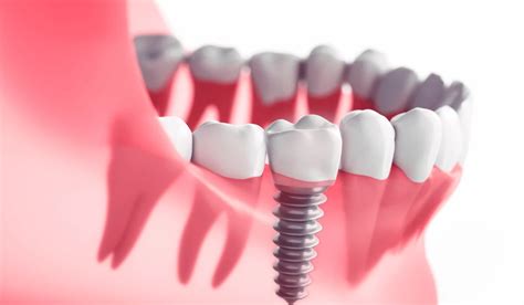 Dental Implant Procedure Everything You Need To Know