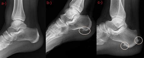 Spurs X Ray Ankle