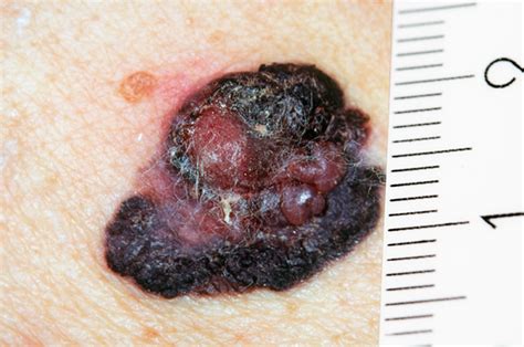 Skin Cancer Melanoma Symptoms Hseie