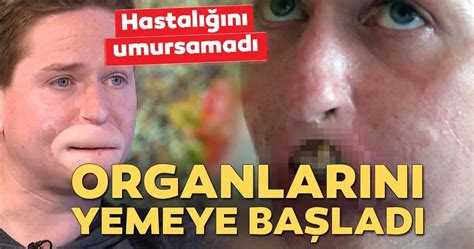 Son Dakika Haber Hastalığını Umursamadı Organlarını Yemeye Başladı